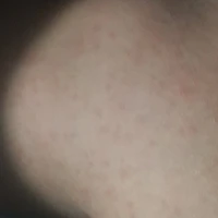 All(ảnh là cái chân bị dị ứng của tui:))